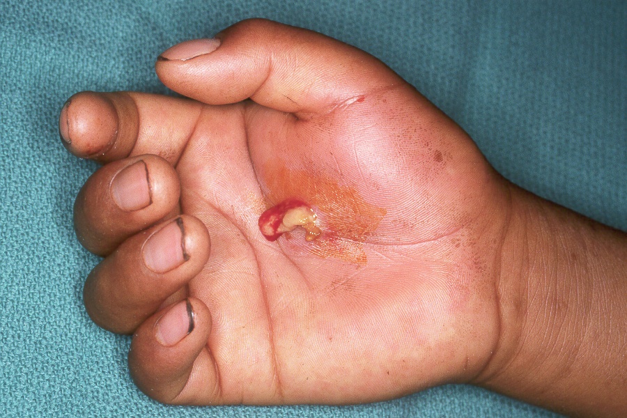 Deep Space Infections